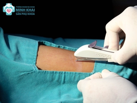 Có Nên Đặt Vòng Tránh Thai Không? Điều Cần Biết Khi Đặt Vòng Tránh Thai