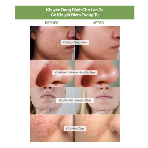 Sữa Rửa Mặt Gilaa Khổ Qua Và Vegan BHA Giảm Mụn 160g Plant Serum Cleanser With Bitter Melon