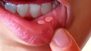 Mách bạn 7 cách chữa nhiệt miệng tại nhà nhanh nhất chỉ sau 1 đêm !!!!