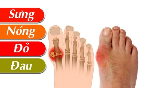 Cách điều trị bệnh Gout hiệu quả? Cách điều trị bệnh Gout hiệu quả? Những biến chứng nguy hiểm