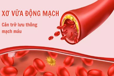 Sản phẩm làm tan mảng xơ vữa