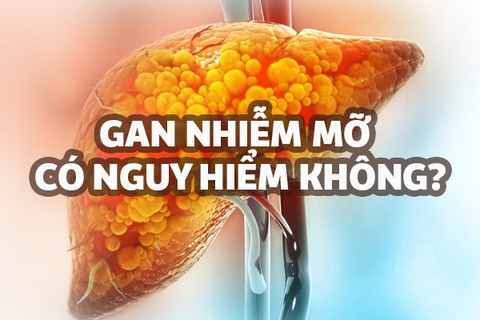 Gan nhiễm mỡ có nguy hiểm không? 5 biến chứng của bệnh gan nhiễm mỡ