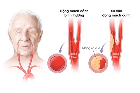 Làm sao để hết xơ vữa động mạch?
