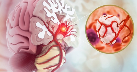 9 dấu hiệu cảnh báo khối u não