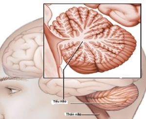Thường xuyên run tay do rối loạn thần kinh, tổn thương não