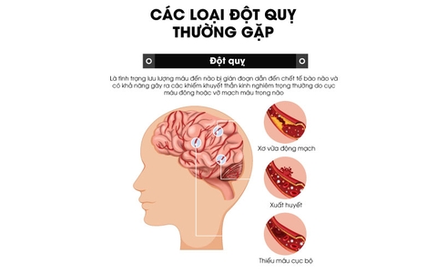 8 nhóm nguyên nhân liên quan nguy cơ đột tử khi ngủ