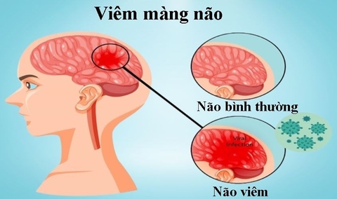 Viêm màng não là bệnh nguy hiểm