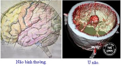 Chẩn đoán u não