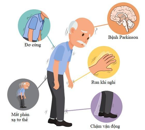 Các triệu chứng thần kinh không liên quan đến bệnh Parkinson