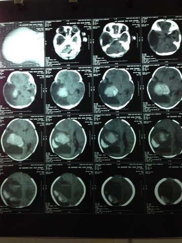 Nguyên nhân gây u não lành tính