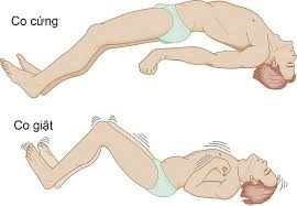 Các cơn động kinh không khởi phát