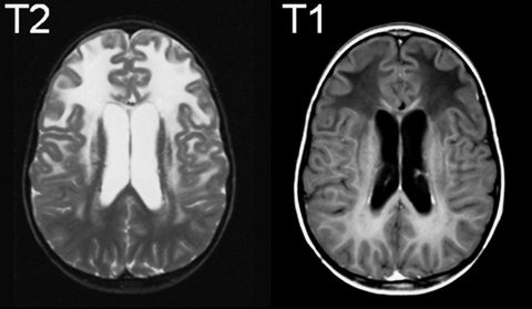 Tổng quan về bệnh lý thoái hóa myelin