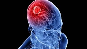 Đau nửa đầu Migraine