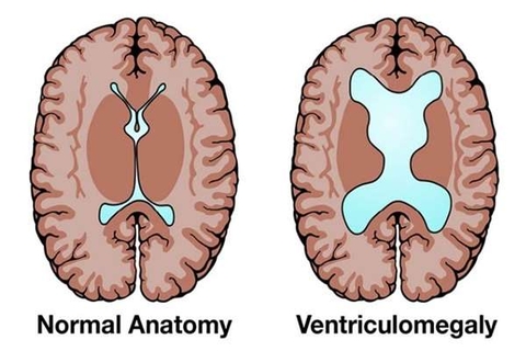 Loạn sản vách thị giác