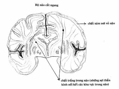 Cảnh giác trước nguy cơ đột quỵ do thoái hóa chất trắng não