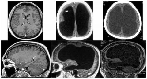 Chết não và cái chết của con người