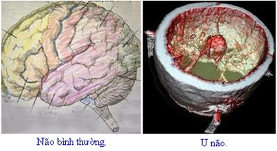 Triệu chứng cảnh báo u não & cách điều trị