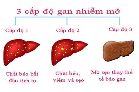 Gan nhiễm mỡ độ 1 là gì?