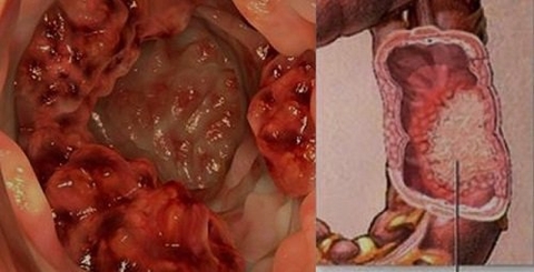 Người bị u não giai đoạn cuối có thể sống được bao lâu?