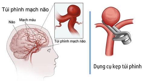 Quy trình vi phẫu thuật kẹp túi phình động mạch não