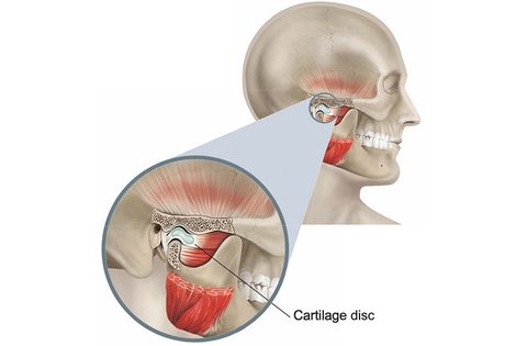 đau nhức xương khớp hàm