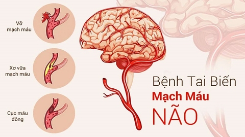 Tai Biến Mạch Máu Não: Nguyên Nhân, Dấu Hiệu Nhận Biết Và Cách Phòng Ngừa Hiệu Quả