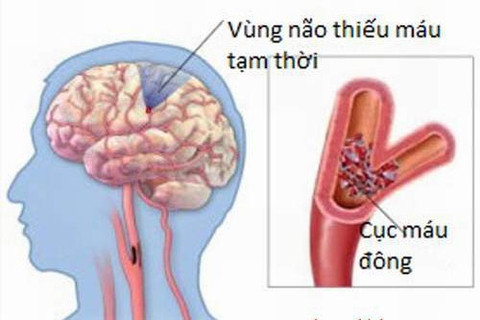 BỆNH NÃO GAN: NGUYÊN NHÂN, PHÂN LOẠI VÀ TRIỆU CHỨNG
