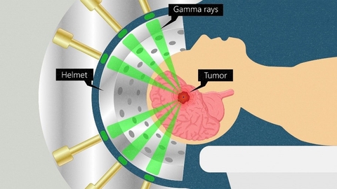 DI CĂN NÃO TRONG UNG THƯ PHỔI