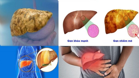 5 thay đổi lối sống có thể đảo ngược bệnh gan nhiễm mỡ