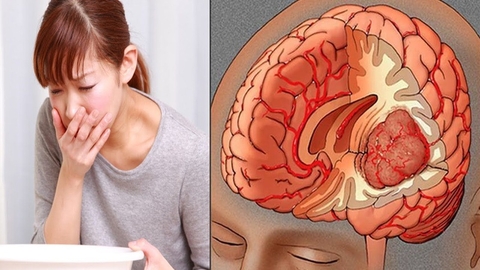 Dấu hiệu u não do vị trí khối u