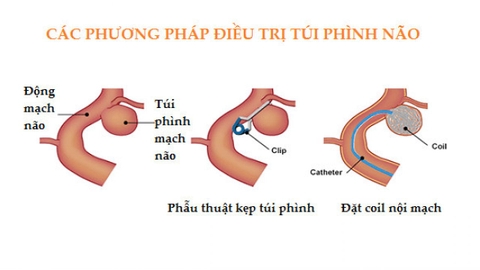 Phẫu thuật kẹp cổ túi phình mạch não phần sau đa giác Willis