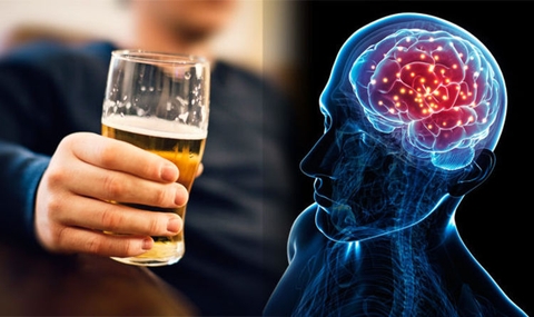 Cảnh Báo Nguy Cơ Xuất Huyết Não Sau Những Cuộc Nhậu Kéo Dài