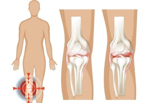 đau nhức xương khớp do lạnh