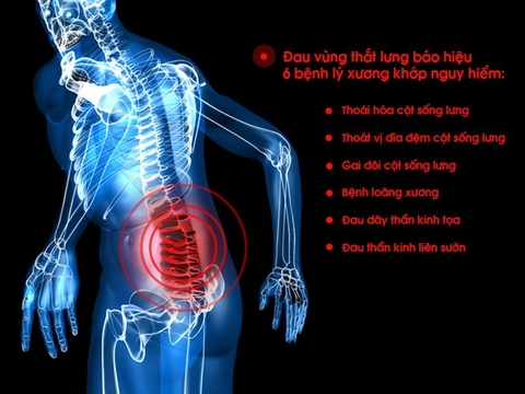Đau thắt lưng bệnh gì?
