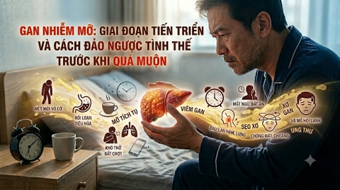 Gan Nhiễm Mỡ: Giai Đoạn Tiến Triển Và Cách Đảo Ngược Tình Thế Trước Khi Quá Muộn