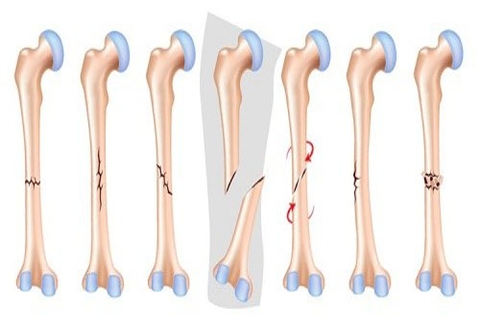 Gãy xương: Nguyên nhân, triệu chứng, cách phòng tránh và điều trị