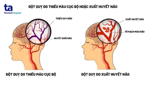 TAI BIẾN MẠCH MÁU NÃO: NGUYÊN NHÂN, TRIỆU CHỨNG VÀ CHẨN ĐOÁN