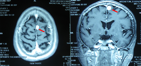 VIÊM MÀNG NÃO Ở TRẺ EM: DẤU HIỆU, NGUYÊN NHÂN VÀ PHÒNG NGỪA