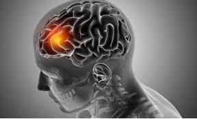 Căn bệnh về não rất nguy hiểm nhưng tuyệt nhiên không có manh mối cảnh báo