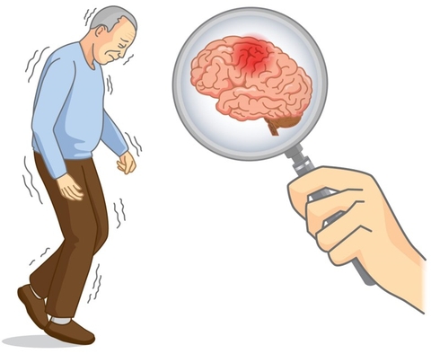 Tổng quan về đau thần kinh