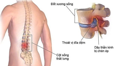 dấu hiệu thoát vị đĩa đệm mông