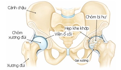 đau nhức xương khớp hông