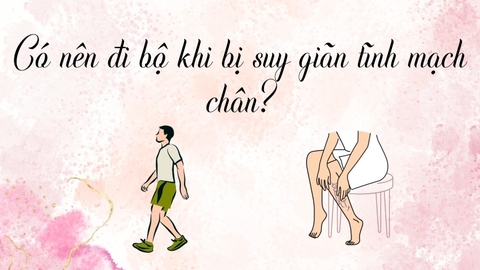 Người bị suy giãn tĩnh mạch có nên đi bộ?
