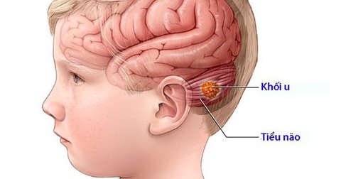 UNG THƯ NÃO: DẤU HIỆU, NGUYÊN NHÂN VÀ CÁCH CHẨN ĐOÁN BỆNH