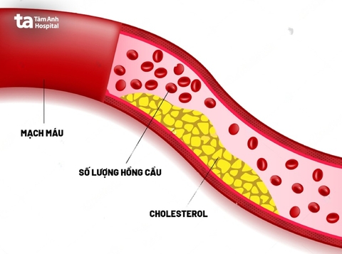 Không ăn thịt mỡ vẫn bị mỡ máu cao: Nguyên nhân do đâu?