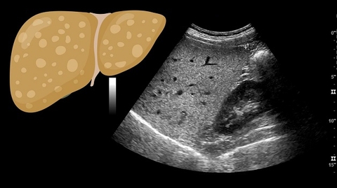 Siêu âm gan nhiễm mỡ và đánh giá mức độ để điều trị