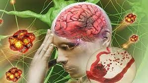 Những di chứng thường gặp do tai biến mạch máu não