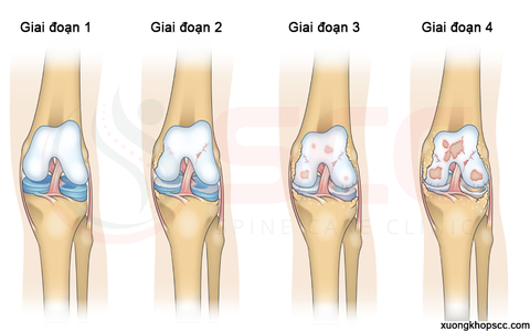 Thoái hóa khớp gối nên uống thuốc gì để hiệu quả