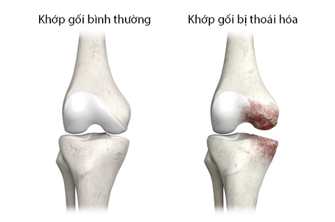 Thoái hóa khớp (OA) - Bệnh thoái hóa khớp, thoái hóa khớp phì đại