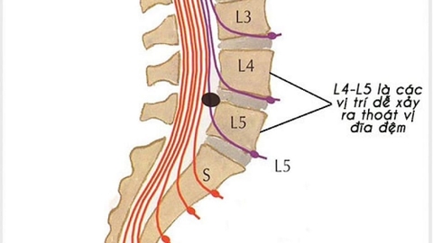 cách chữa thoát vị đĩa đệm l4 l5